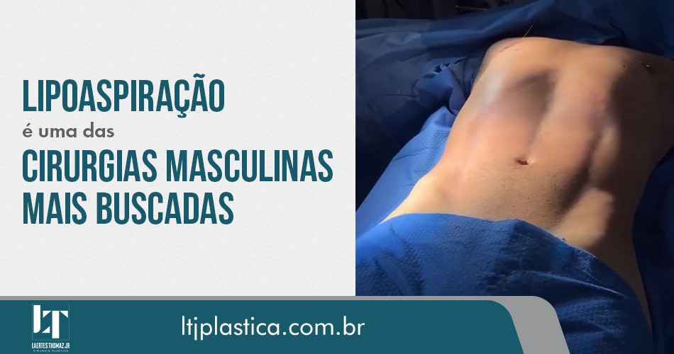 Lipo 3D - Cirurgia de Lipo 3D